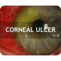Corneal ulcer