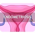 Endometriosis