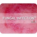 Fungal Infection